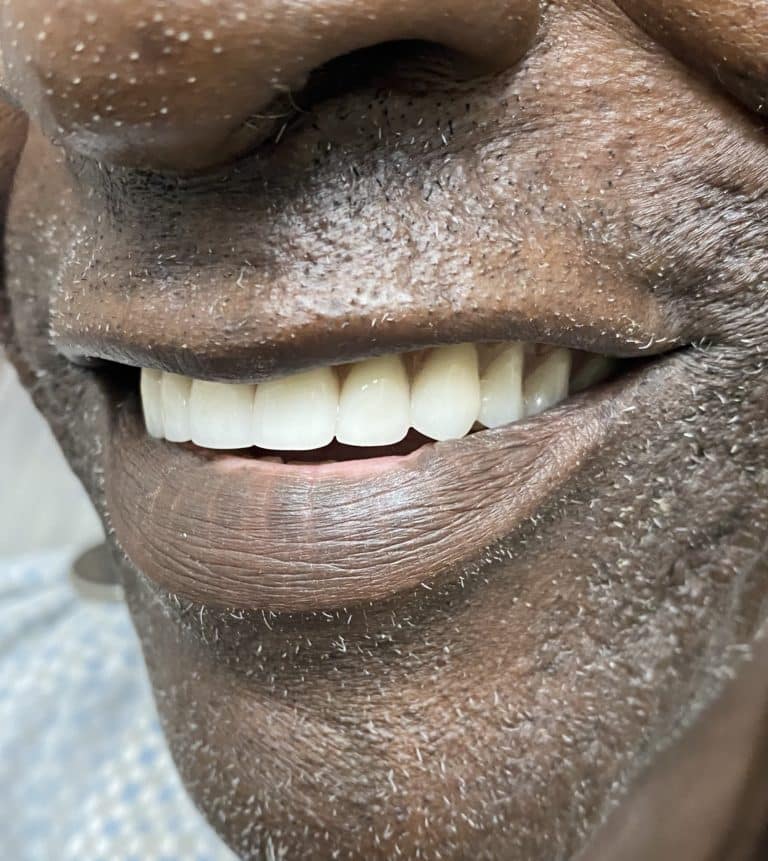After Image: Upper Full-Arch with Multiple Implants and Implant Bridge - left-front-oblique