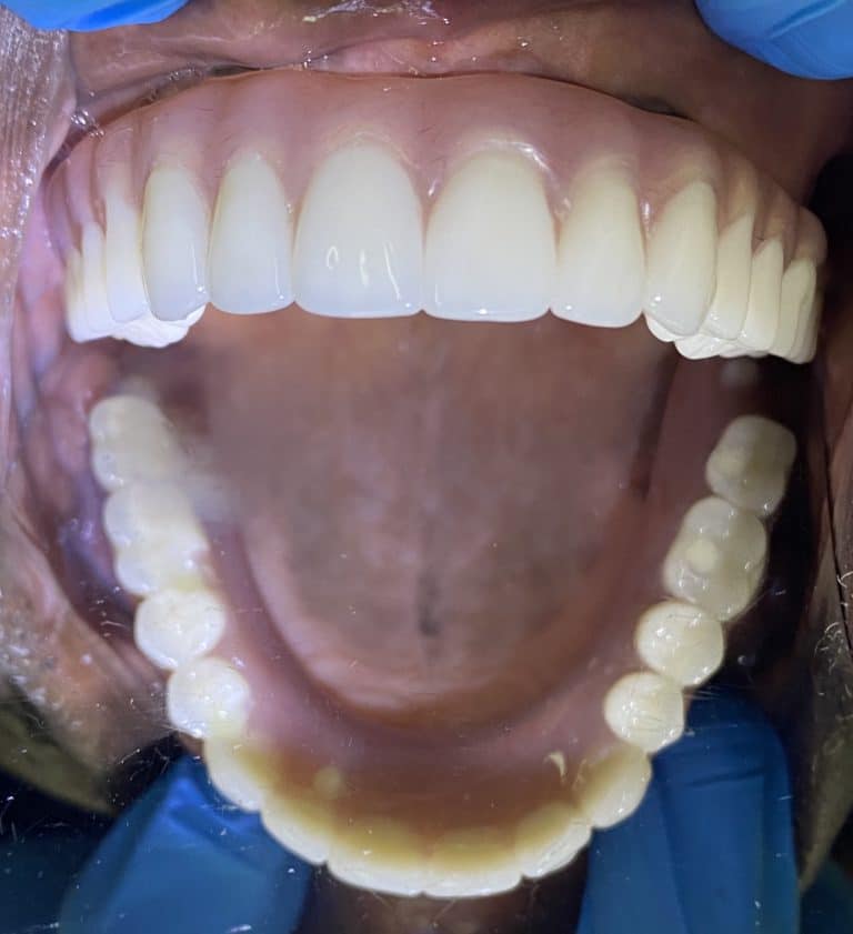 After Image: Upper Full-Arch with Multiple Implants and Implant Bridge - front