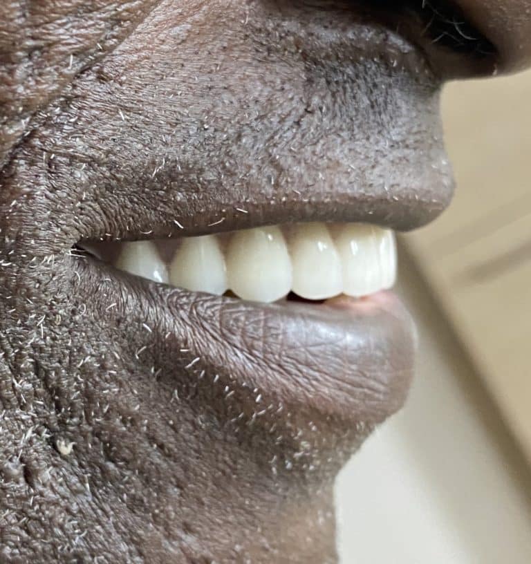 After Image: Upper Full-Arch with Multiple Implants and Implant Bridge - right-side