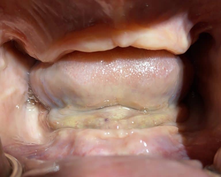 Before Image: Placement of 2 Implants for Better Retainment of an Old Denture - front