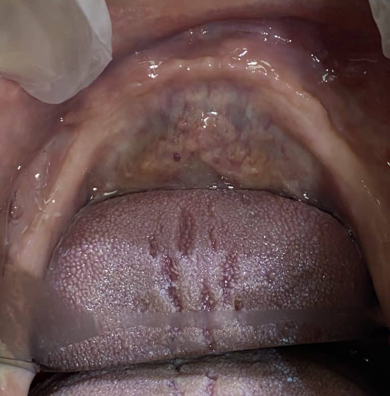 Before Image: Placement of 2 Implants for Better Retainment of an Old Denture - other