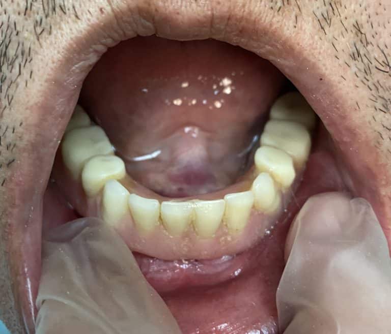 After Image: Placement of 2 Implants for Better Retainment of an Old Denture - front