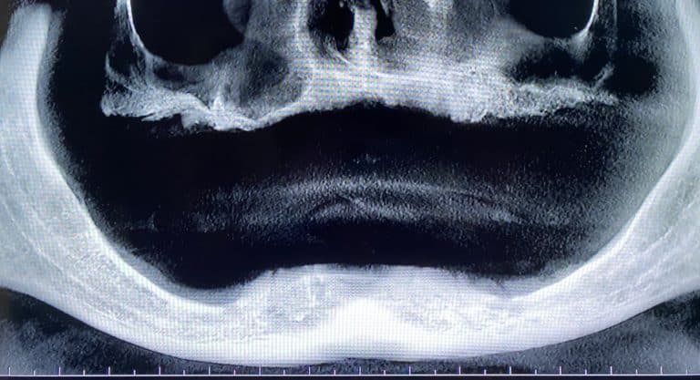 Before Image: Placement of 2 Implants for Better Retainment of an Old Denture - left-side