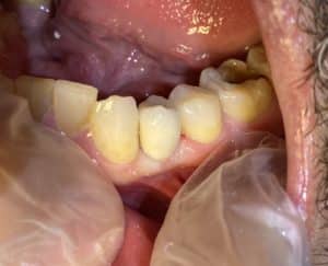 Single Implant Placement in the Posterior Region following a Tooth Extraction