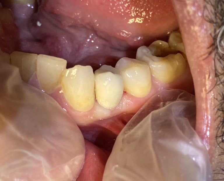 After Image: Single Implant Placement in the Posterior Region following a Tooth Extraction - left-side