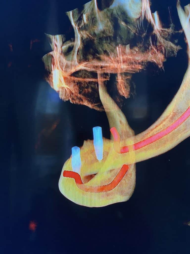 After Image: Placement of 2 Implants for Better Retainment of an Old Denture - left-side