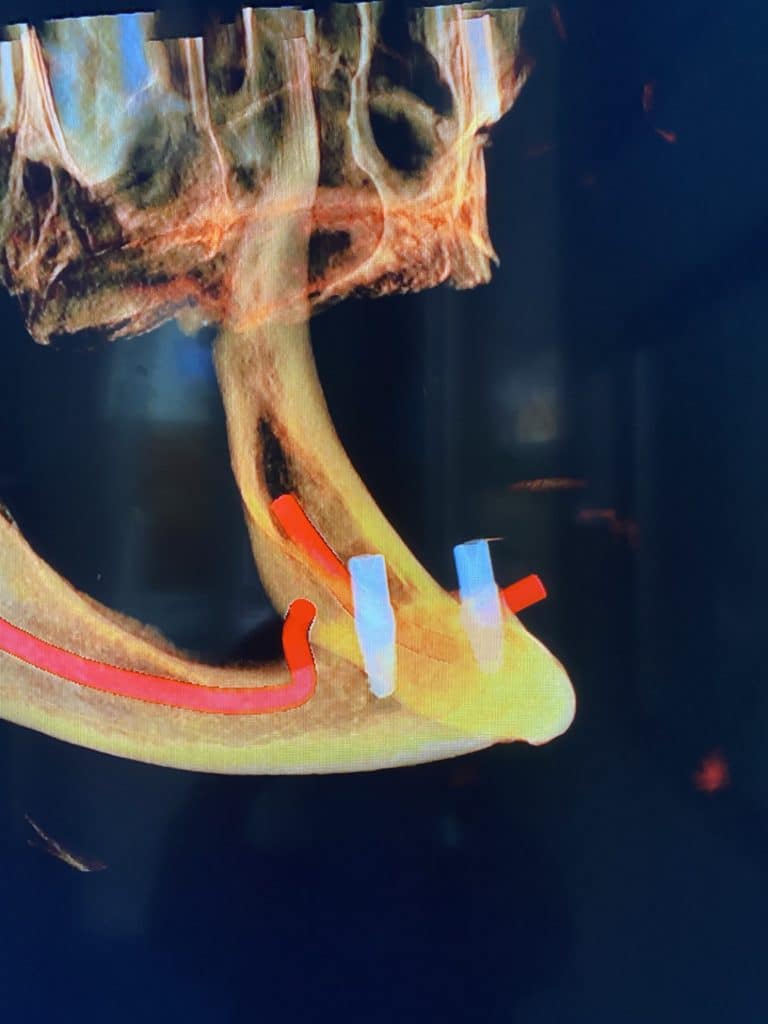After Image: Placement of 2 Implants for Better Retainment of an Old Denture - right-side
