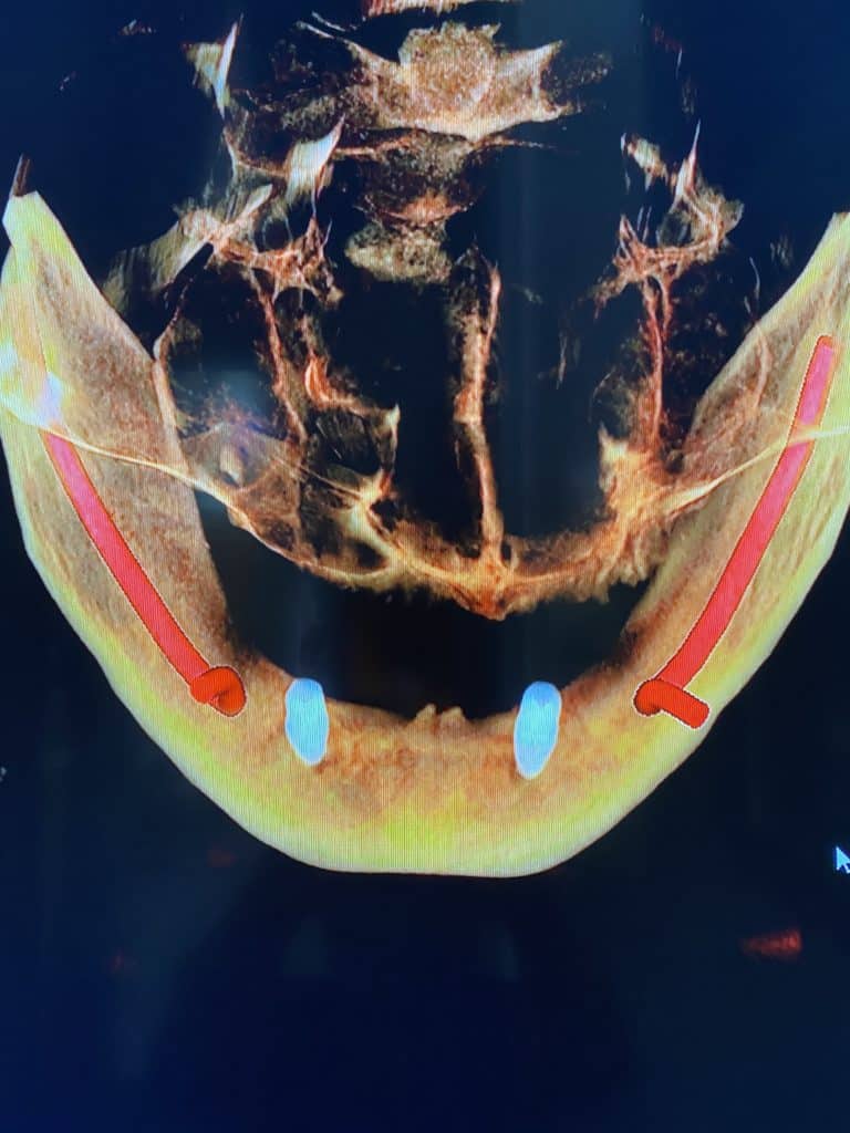 After Image: Placement of 2 Implants for Better Retainment of an Old Denture - other