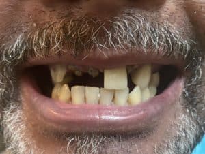 Before Image: Upper Full-Arch Implants with Oral Prosthesis