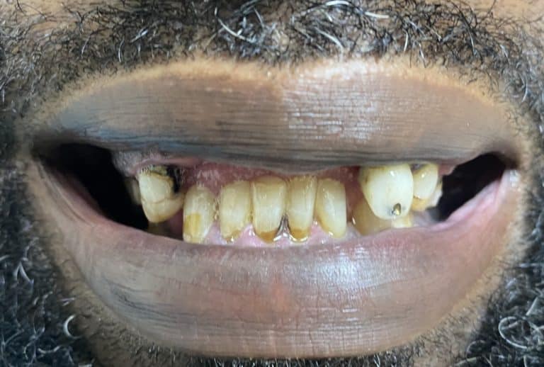 Before Image: 3 Anterior Dental Implants with “Pink Porcelain” Oral Prosthesis - front