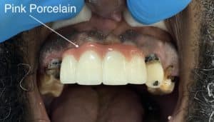 3 Anterior Dental Implants with “Pink Porcelain” Oral Prosthesis