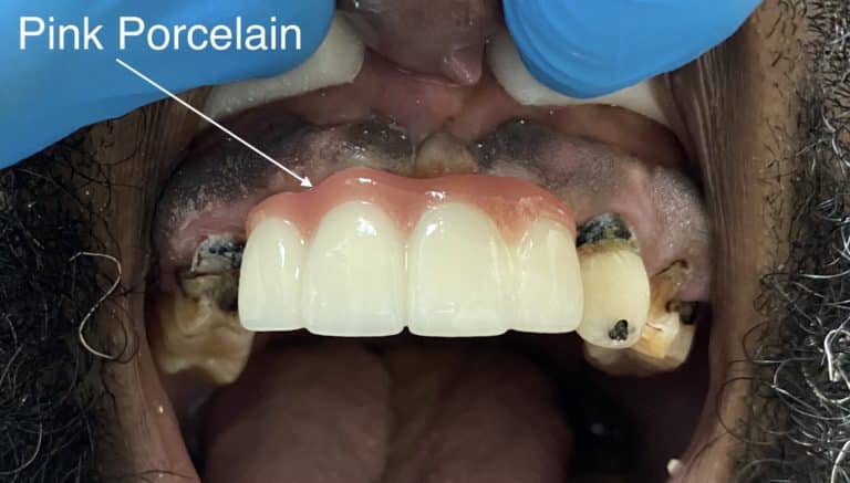 After Image: 3 Anterior Dental Implants with “Pink Porcelain” Oral Prosthesis - front