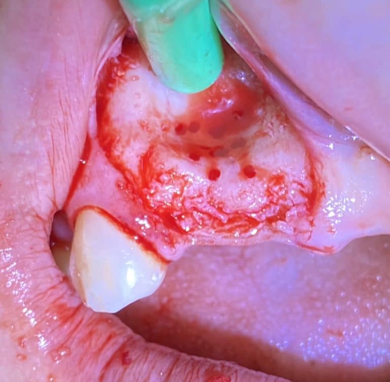 After Image: *Graphic Images* Bone Block Grafting in the Anterior Region - front