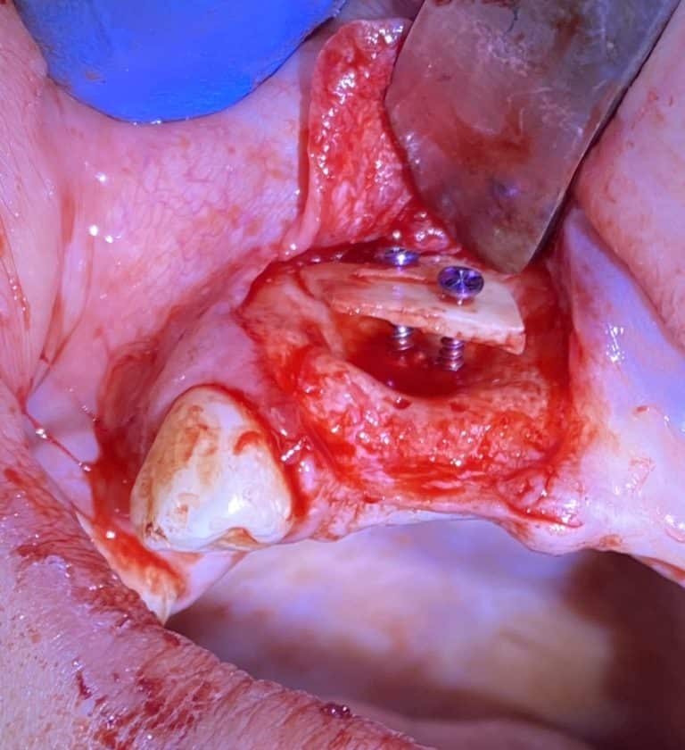 After Image: *Graphic Images* Bone Block Grafting in the Anterior Region - front