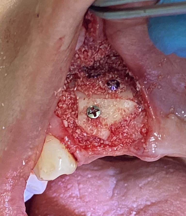 After Image: *Graphic Images* Bone Block Grafting in the Anterior Region - front