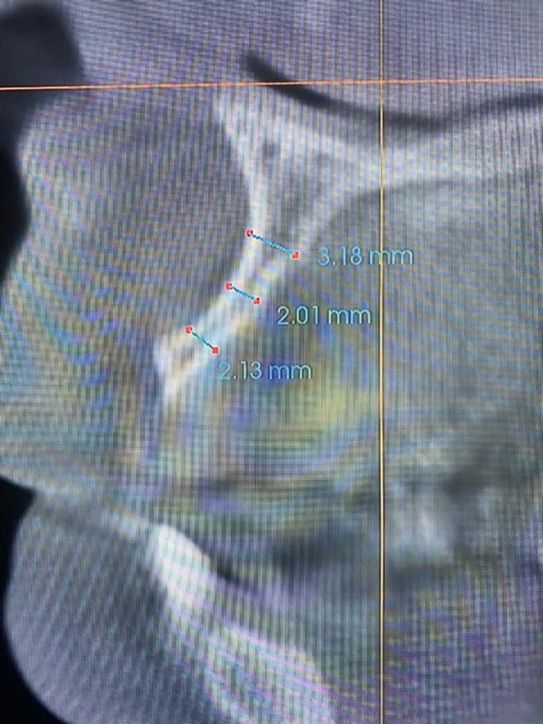 Before Image: *Graphic Images* Bone Block Grafting in the Anterior Region - front