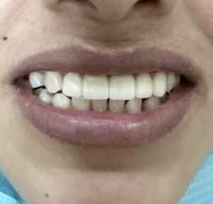 After Image: *Graphic Images* Bone Block Grafting in the Anterior Region