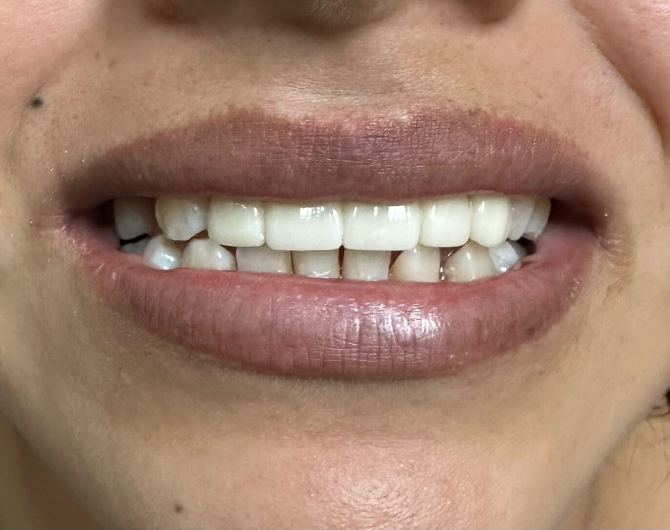 After Image: *Graphic Images* Bone Block Grafting in the Anterior Region - front