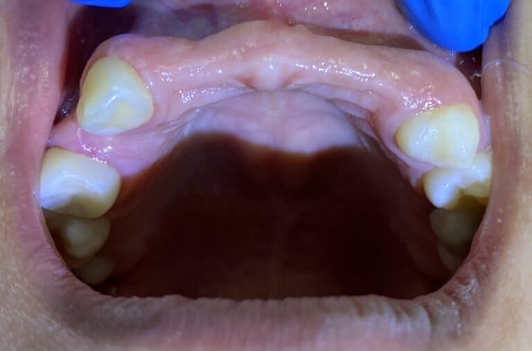 Before Image: *Graphic Images* Bone Block Grafting in the Anterior Region - front