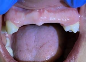 Before Image: *Graphic Images* Bone Block Grafting in the Anterior Region