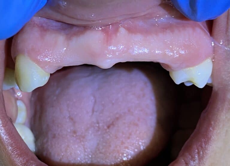 Before Image: *Graphic Images* Bone Block Grafting in the Anterior Region - front