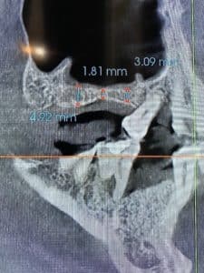 Before Image: Sinus Lift via Lateral Window Approach with Bone Graft and Implant Placements