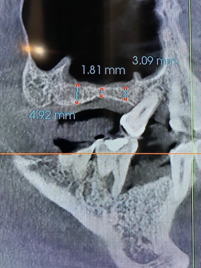Before Image: Sinus Lift via Lateral Window Approach with Bone Graft and Implant Placements - front