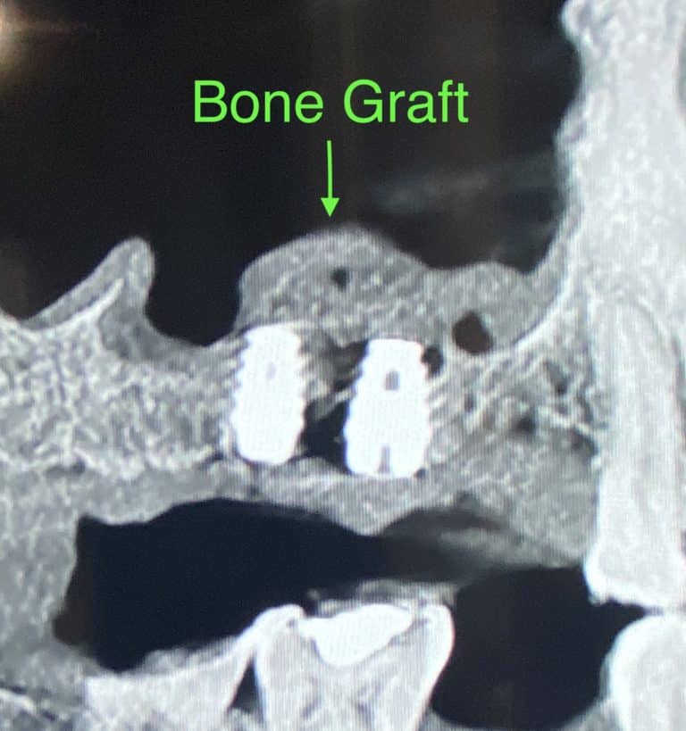 After Image: Sinus Lift via Lateral Window Approach with Bone Graft and Implant Placements - front