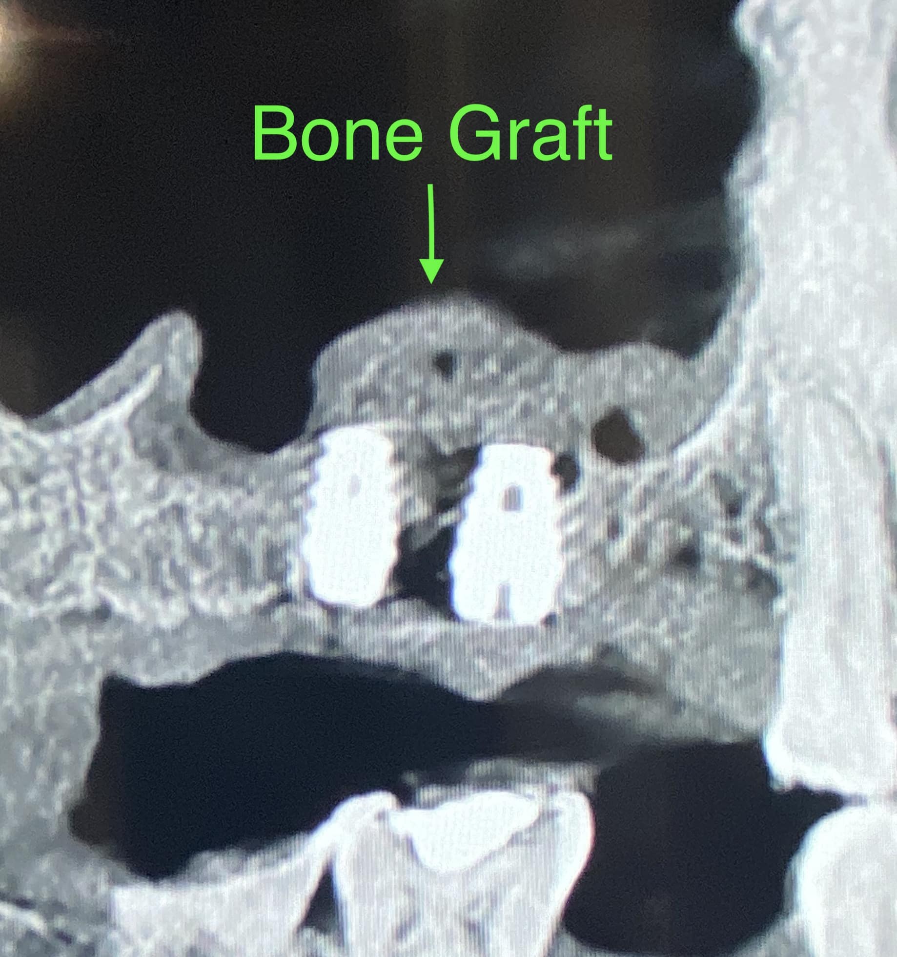 Sinus Lift via Lateral Window Approach with Bone Graft and Implant Placements