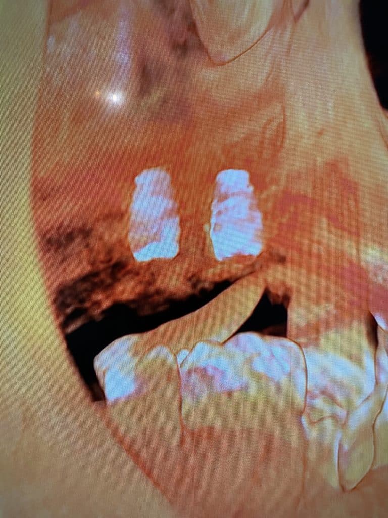 After Image: Sinus Lift via Lateral Window Approach with Bone Graft and Implant Placements - front