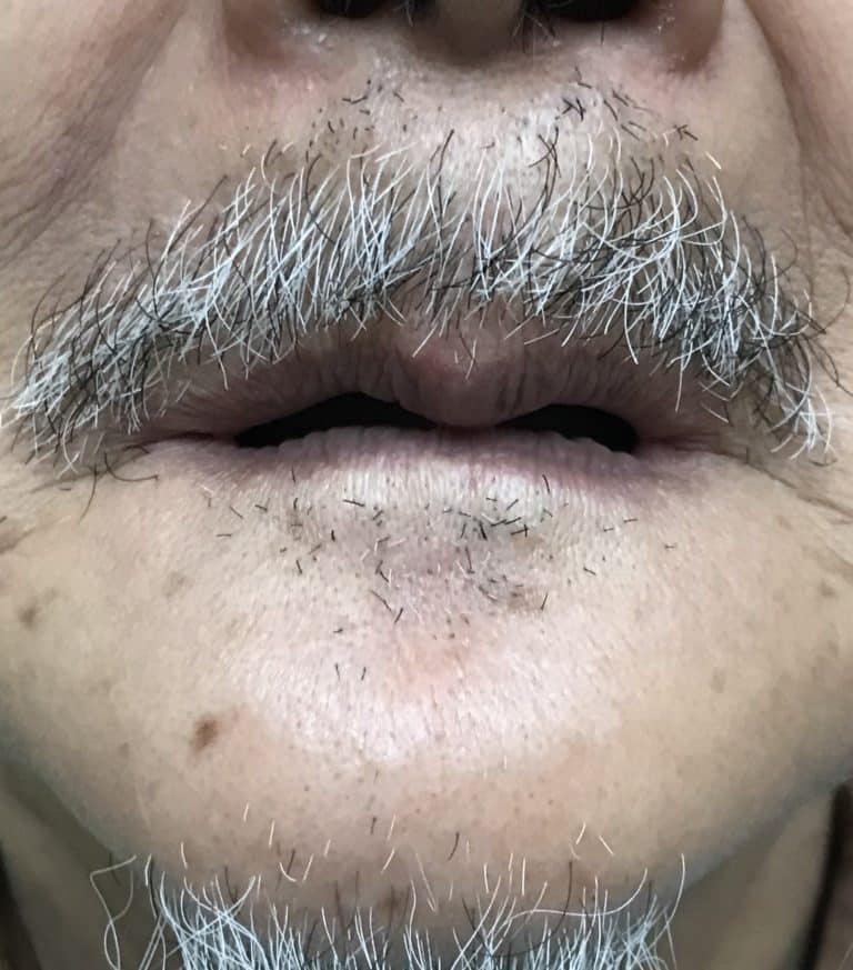 Before Image: Full Mouth Oral Prostheses: Upper Full-Arch Screw-Retained (Non-Removable) Hybrid FP-3 Oral Prosthesis and Lower Implant Overdenture (Snap-on) - front