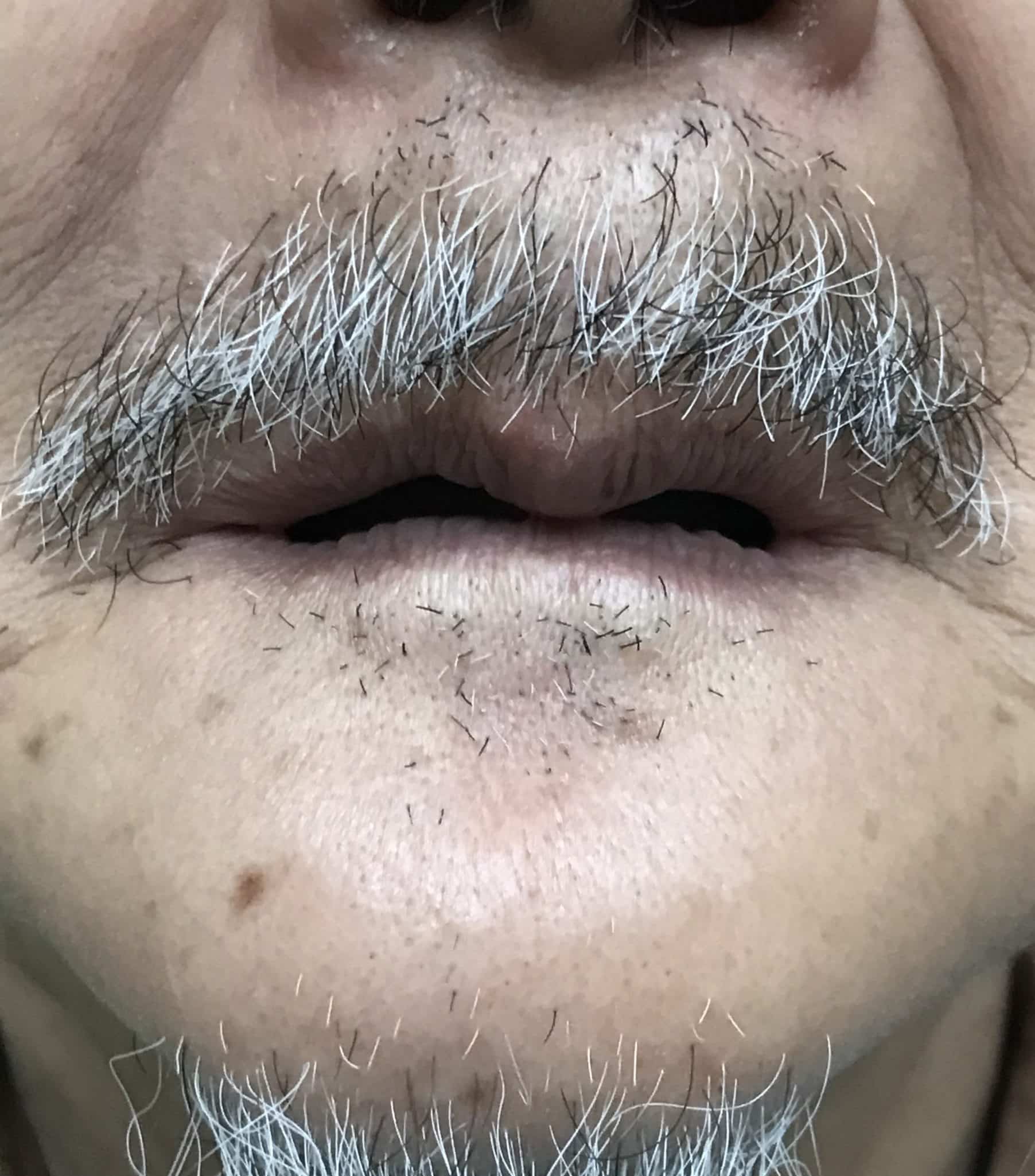Upper Full-Arch Screw-Retained (Non-Removable) Hybrid FP-3 Oral Prosthesis and Lower Implant Overdenture (Snap-on)