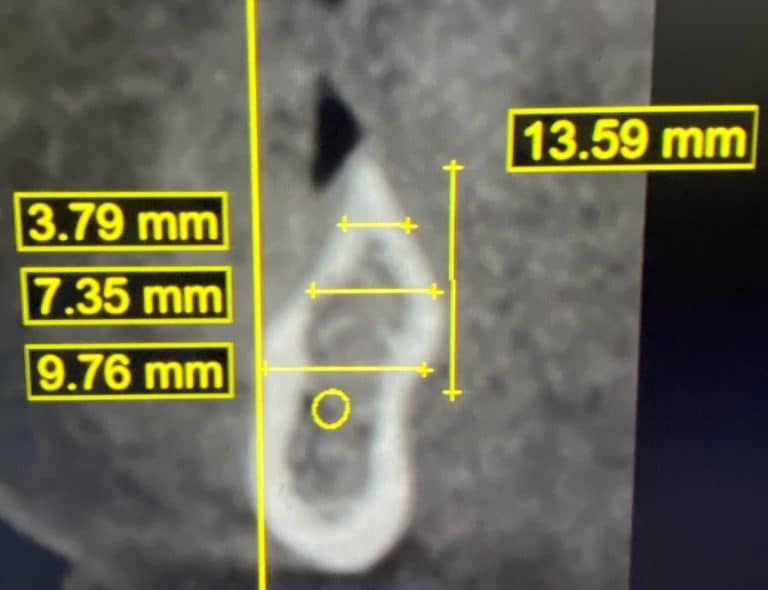 Before Image: 2 Posterior Implants in the Posterior Region after Transplantation of a Bone Block Graft - front