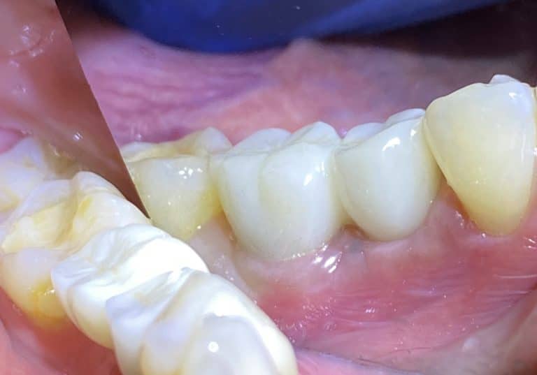 After Image: 2 Posterior Implants in the Posterior Region after Transplantation of a Bone Block Graft - front