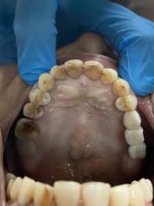 Before Image: 6 Dental Implants Placement without Surgical Incisions or Flaps for a Full-Arch Implant Prosthesis
