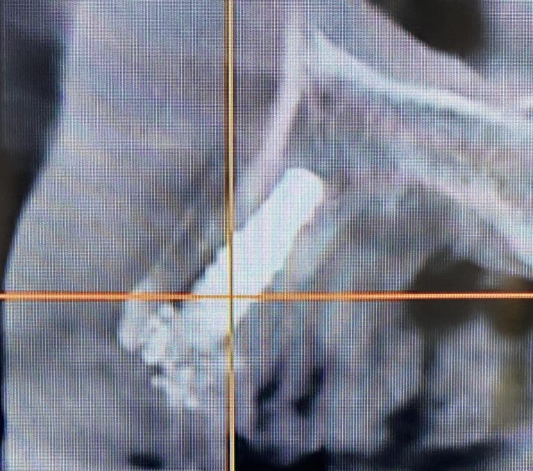 After Image: 6 Dental Implants Placement without Surgical Incisions or Flaps for a Full-Arch Implant Prosthesis - front