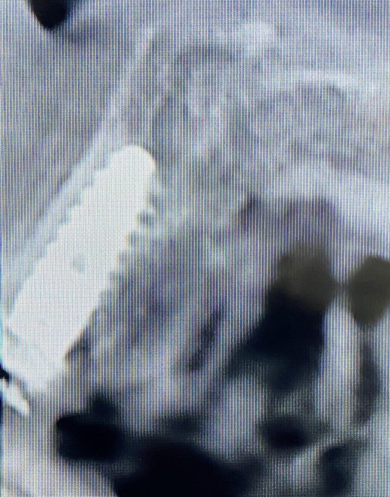 After Image: 6 Dental Implants Placement without Surgical Incisions or Flaps for a Full-Arch Implant Prosthesis - front
