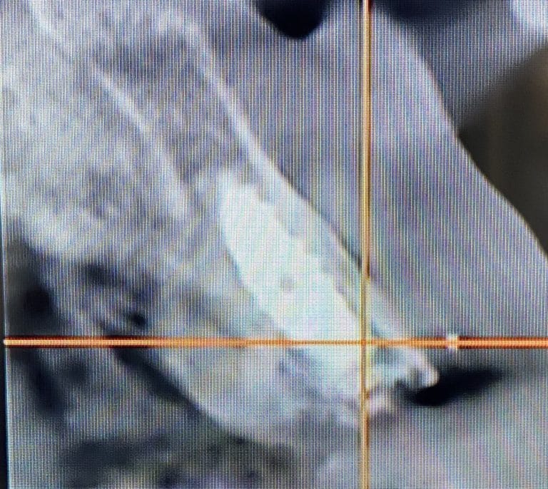 After Image: 6 Dental Implants Placement without Surgical Incisions or Flaps for a Full-Arch Implant Prosthesis - front