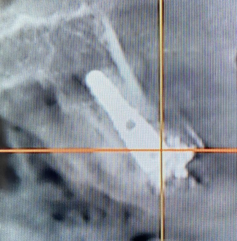 After Image: 6 Dental Implants Placement without Surgical Incisions or Flaps for a Full-Arch Implant Prosthesis - front