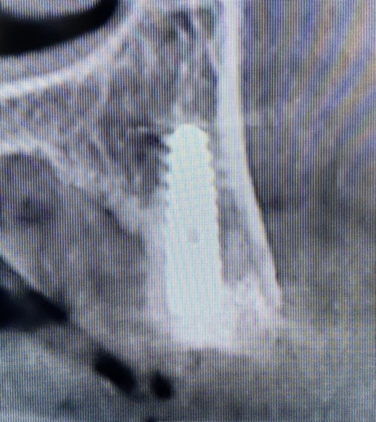 After Image: 6 Dental Implants Placement without Surgical Incisions or Flaps for a Full-Arch Implant Prosthesis - front