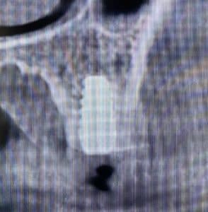 6 Dental Implants Placement without Surgical Incisions or Flaps for a Full-Arch Implant Prosthesis