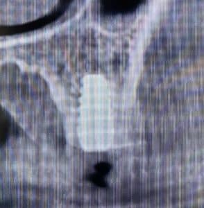 After Image: 6 Dental Implants Placement without Surgical Incisions or Flaps for a Full-Arch Implant Prosthesis
