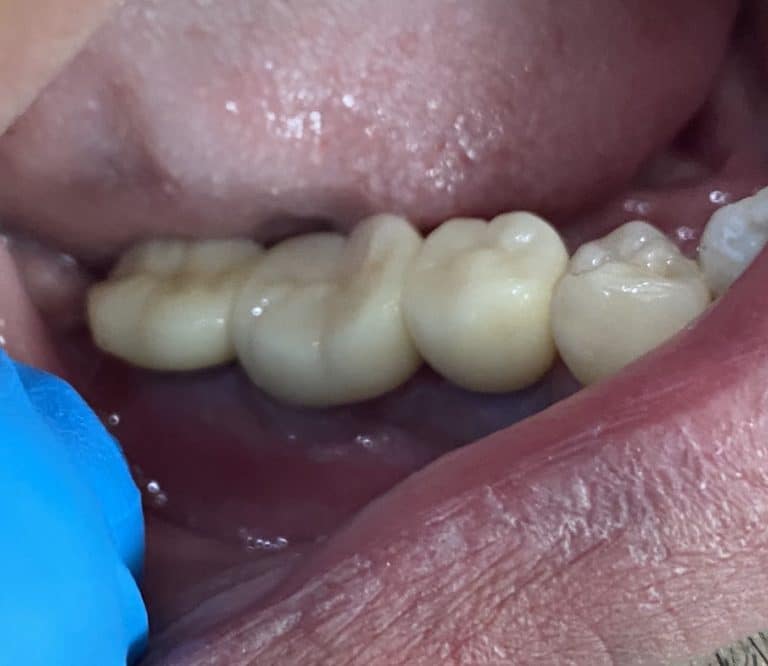 After Image: 3 Dental Implants with Vertical and Horizontal Bone Block Graft Augmentation - front