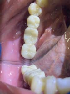 After Image: 3 Dental Implants with Vertical and Horizontal Bone Block Graft Augmentation