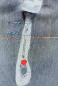 Before Image: 3 Dental Implants with Vertical and Horizontal Bone Block Graft Augmentation