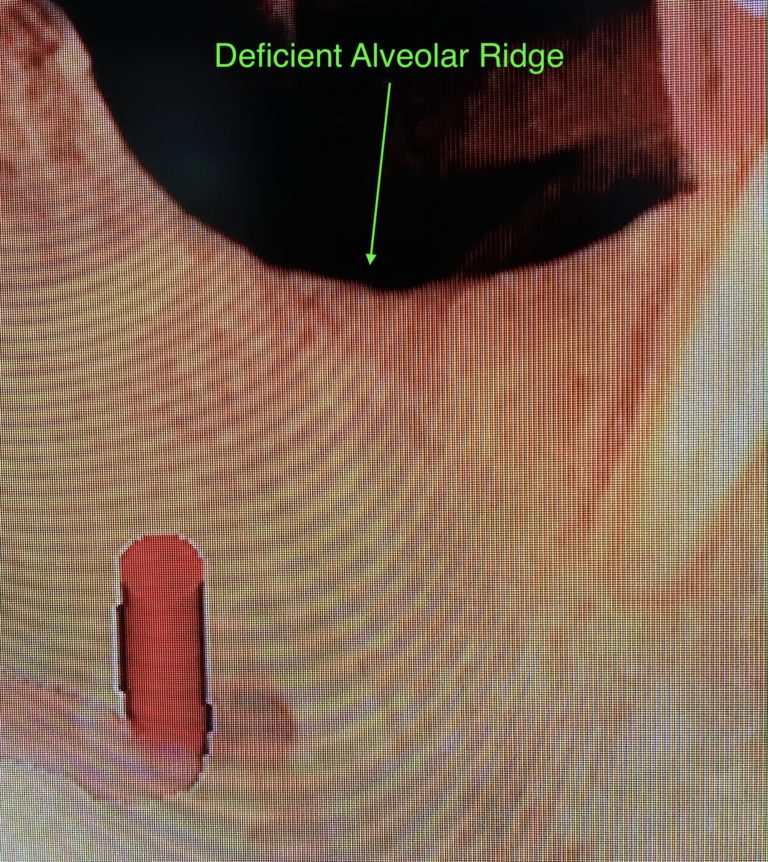 Before Image: 3 Dental Implants with Vertical and Horizontal Bone Block Graft Augmentation - front