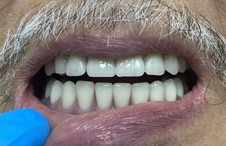 After Image: Full Mouth Oral Prostheses: Upper Full-Arch Screw-Retained (Non-Removable) Hybrid FP-3 Oral Prosthesis and Lower Implant Overdenture (Snap-on) - front