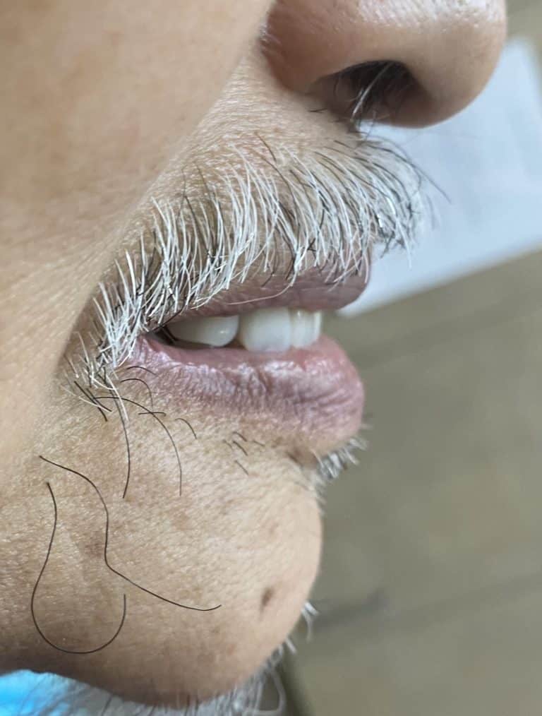 After Image: Full Mouth Oral Prostheses: Upper Full-Arch Screw-Retained (Non-Removable) Hybrid FP-3 Oral Prosthesis and Lower Implant Overdenture (Snap-on) - right-side