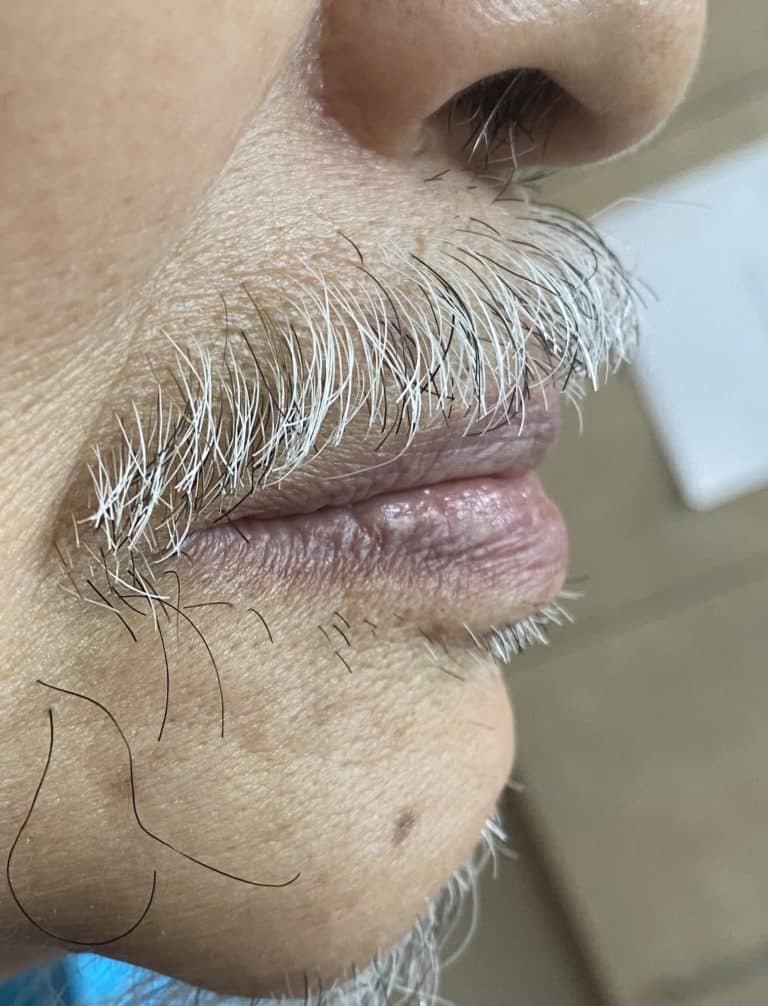 After Image: Full Mouth Oral Prostheses: Upper Full-Arch Screw-Retained (Non-Removable) Hybrid FP-3 Oral Prosthesis and Lower Implant Overdenture (Snap-on) - right-side
