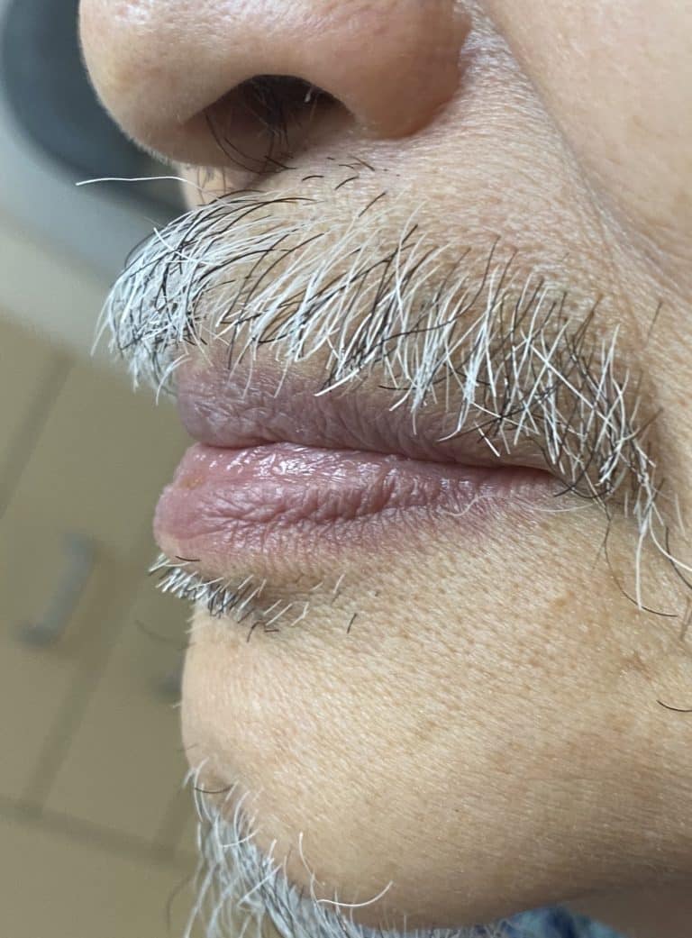 After Image: Full Mouth Oral Prostheses: Upper Full-Arch Screw-Retained (Non-Removable) Hybrid FP-3 Oral Prosthesis and Lower Implant Overdenture (Snap-on) - left-side
